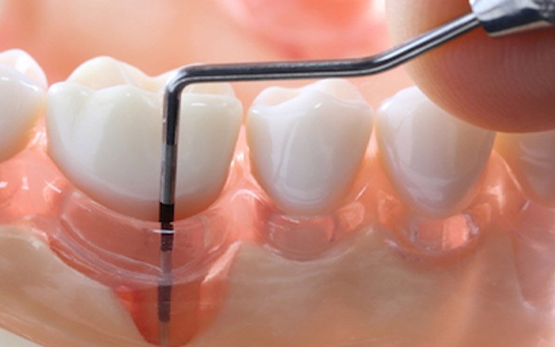 periodontal treatment
