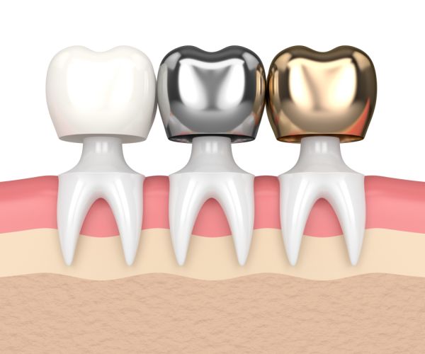 Types of Dental Crown
